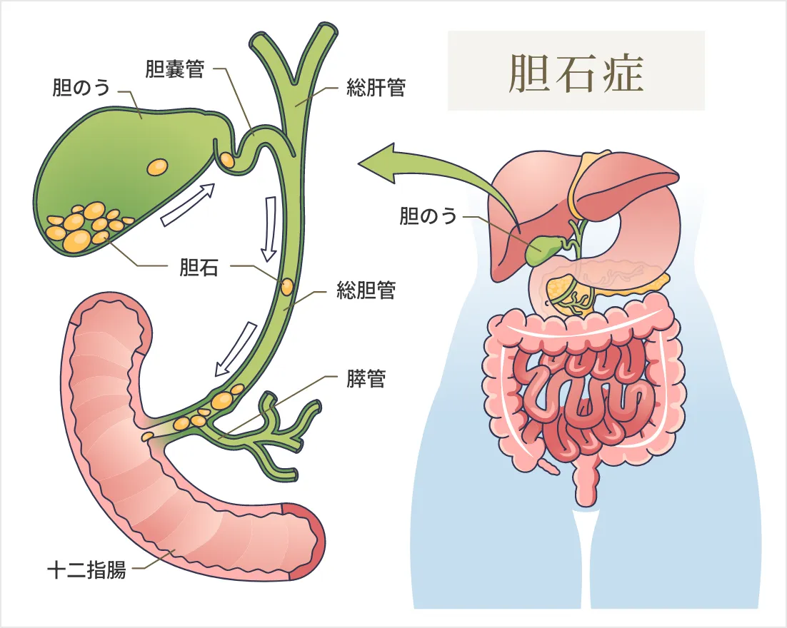 胆石症の状態のイラスト