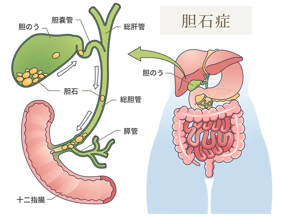 胆石症について